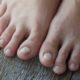 How to get rid of yellow toenails?