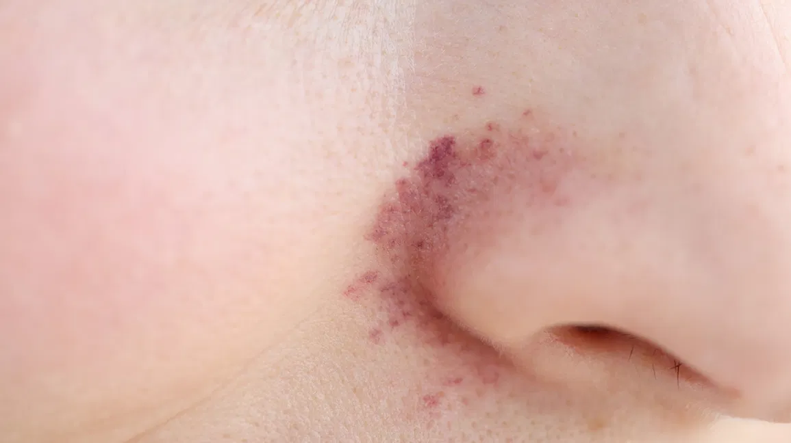 How to get rid of redness around nose?